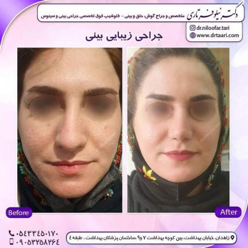 جراحی بینی در زاهدان 37