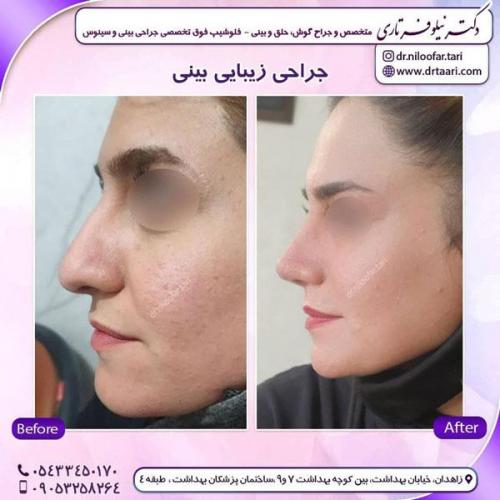 جراحی بینی در زاهدان 38