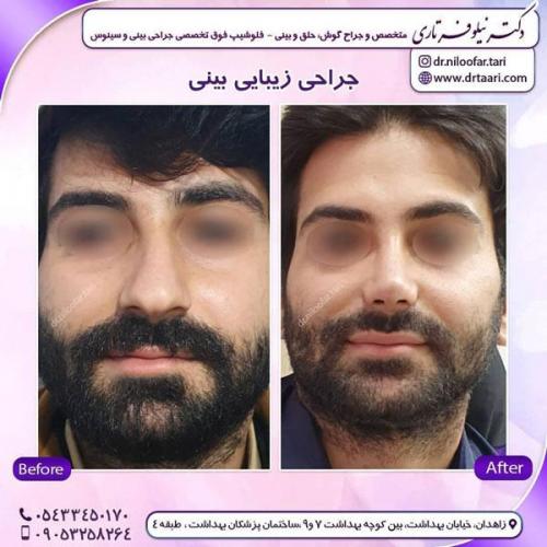 جراحی بینی در زاهدان 39