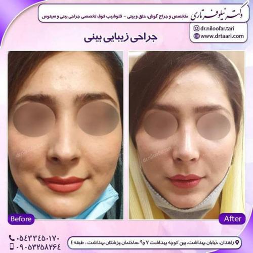 جراحی بینی در زاهدان 4