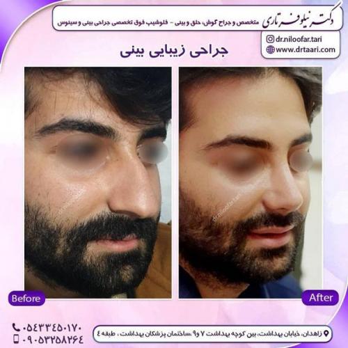 جراحی بینی در زاهدان 40