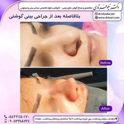 جراحی بینی در زاهدان 41