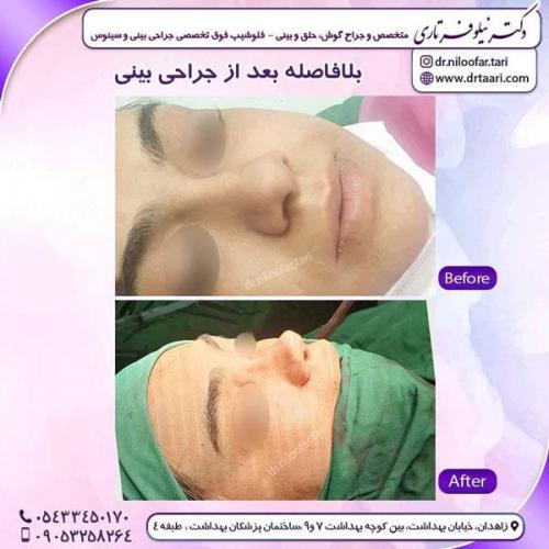 جراحی بینی در زاهدان 43