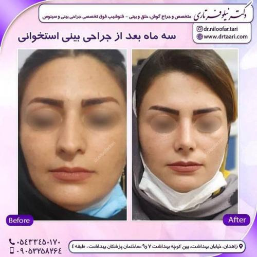 جراحی بینی در زاهدان 44