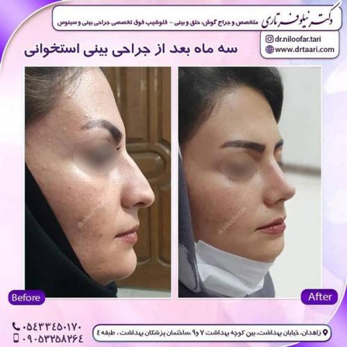 جراحی بینی در زاهدان 46