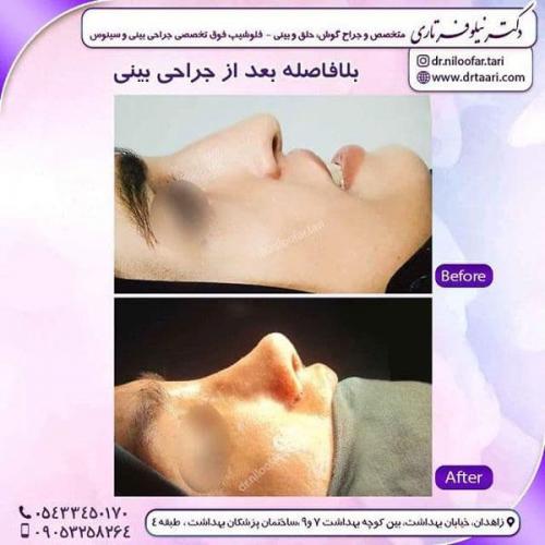 جراحی بینی در زاهدان 47