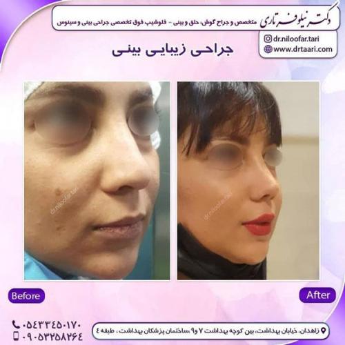 جراحی بینی در زاهدان 48