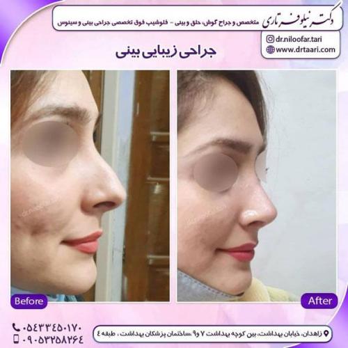 جراحی بینی در زاهدان 5