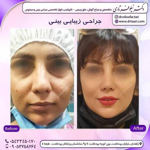 جراحی بینی در زاهدان 50