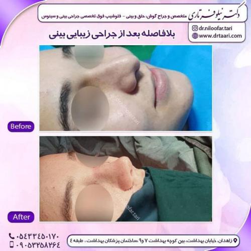جراحی بینی در زاهدان 6