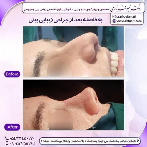 جراحی بینی در زاهدان 7