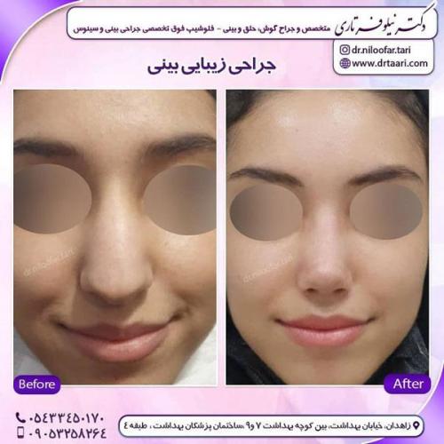 جراحی بینی در زاهدان 8
