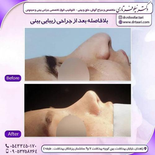 جراحی بینی در زاهدان 9