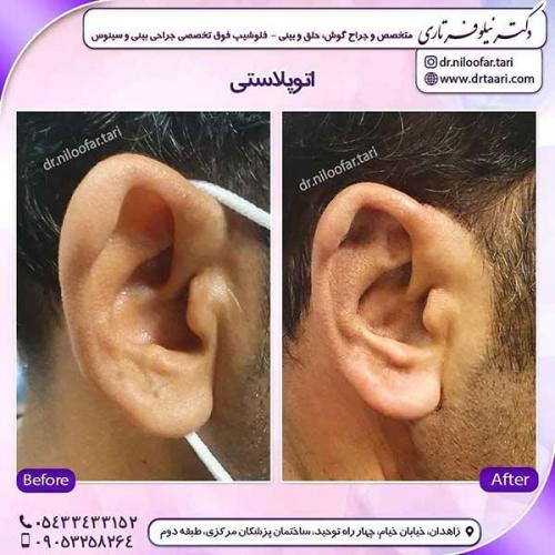 جراحی-گوش-8